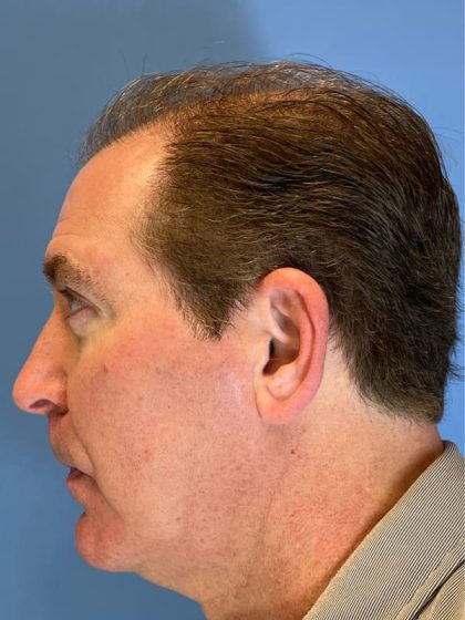 Hair Transplant Before & After Patient #6913