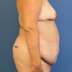 Lipoabdominoplasty Before & After Patient #5549