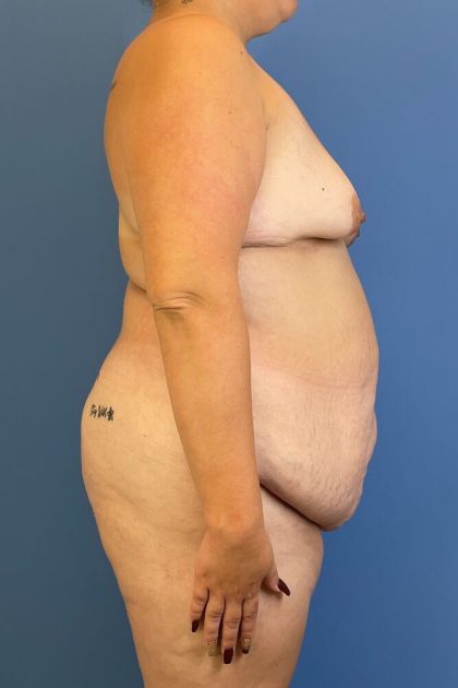 Lipoabdominoplasty Before & After Patient #5549