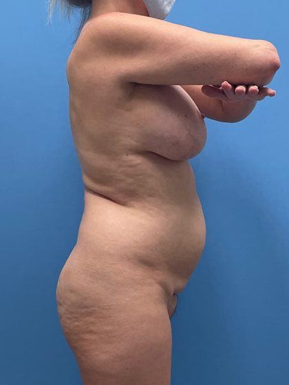 Lipoabdominoplasty Before & After Patient #5605