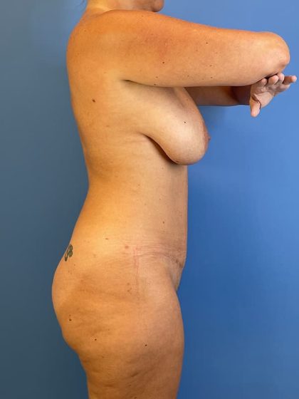 Vaser Liposuction Before & After Patient #5709