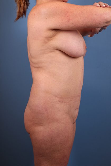 Vaser Liposuction Before & After Patient #5713