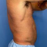 Vaser Liposuction Before & After Patient #5832