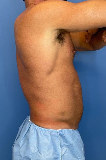 Male Liposuction Before & After Patient #5832