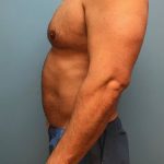 Hi-Def Liposuction Before & After Patient #5454