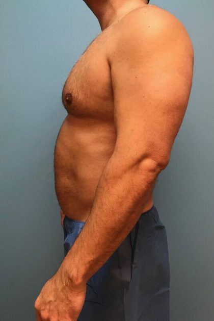 Hi-Def Liposuction Before & After Patient #5454