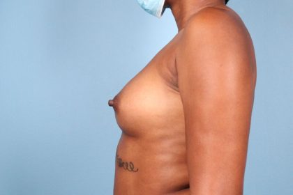 Breast Augmentation Before & After Patient #6176