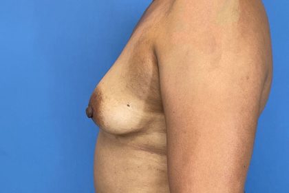 Breast Augmentation Before & After Patient #6297
