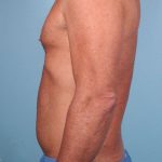 Hi-Def Liposuction Before & After Patient #5456