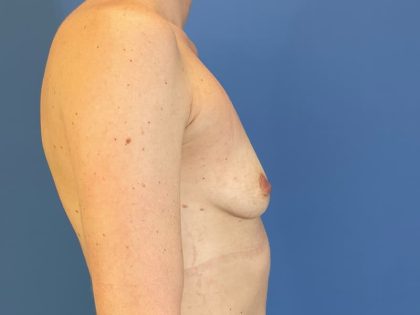 Breast Augmentation Before & After Patient #6336