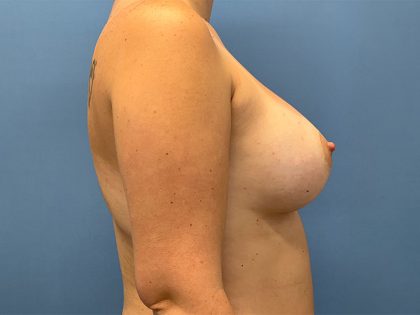Breast Augmentation Before & After Patient #6421