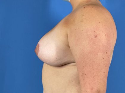 Breast Lift Before & After Patient #6510