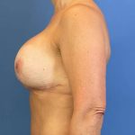 Breast Lift Before & After Patient #6512