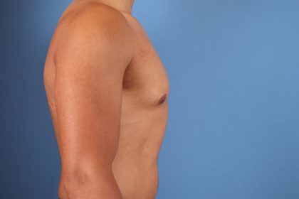 Gynecomastia Before & After Patient #6648
