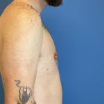Gynecomastia Before & After Patient #6650