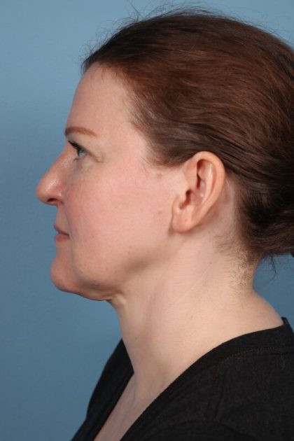 Face & Neck Lift Before & After Patient #6808
