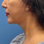 Face & Neck Lift Before & After Patient #6812