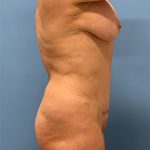 Vaser Liposuction Before & After Patient #5713