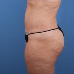 Vaser Liposuction Before & After Patient #5714