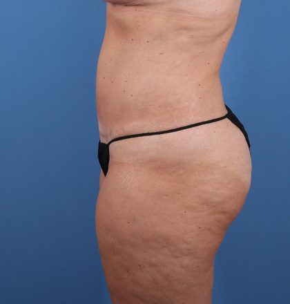 Vaser Liposuction Before & After Patient #5714