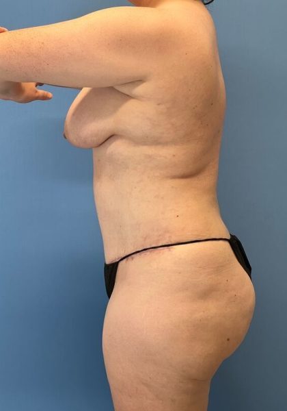 Tummy Tuck Before & After Patient #6048