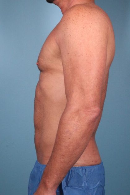 Hi-Def Liposuction Before & After Patient #5456