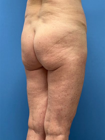 Brazilian Butt Lift (BBL) Before & After Patient #5377