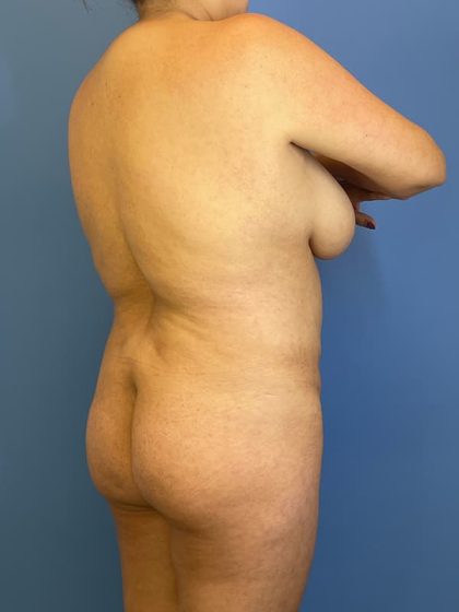 Vaser Liposuction Before & After Patient #5710