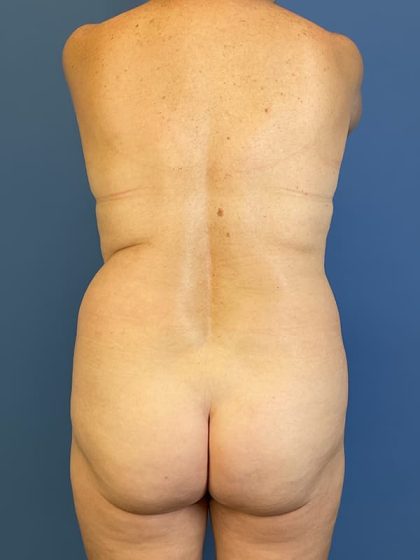 Vaser Liposuction Before & After Patient #5711