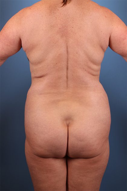 Liposuction Before & After Patient #5713