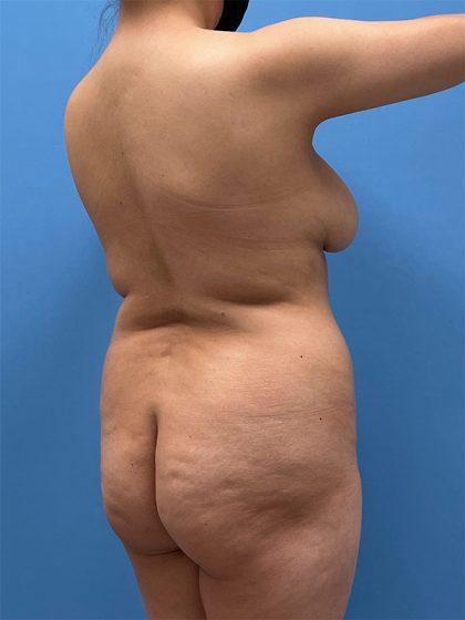 Brazilian Butt Lift (BBL) Before & After Patient #5378