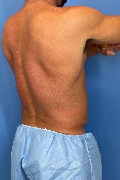 Male Liposuction Before & After Patient #5832