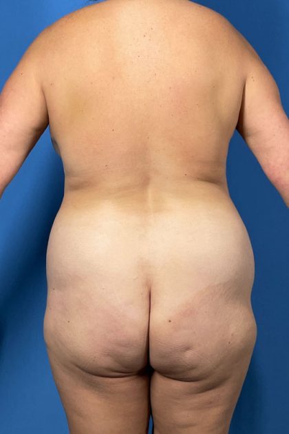 Brazilian Butt Lift Before & After Patient #5352