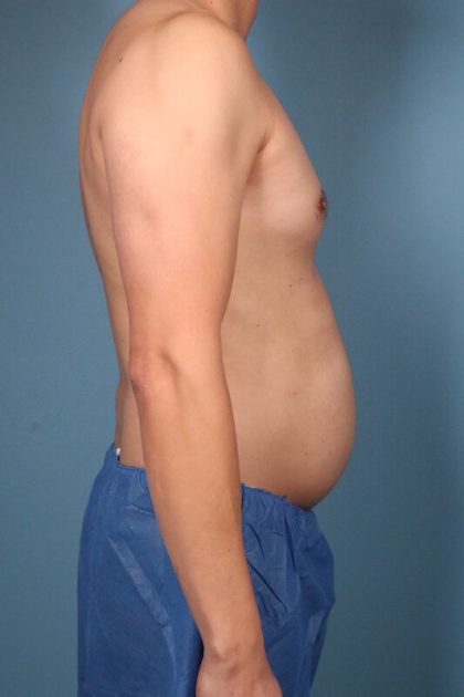 Hi-Def Liposuction Before & After Patient #5453