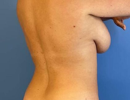 Breast Lift with Augmentation Before & After Patient #6515