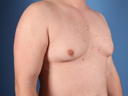 Gynecomastia Before & After Patient #6653