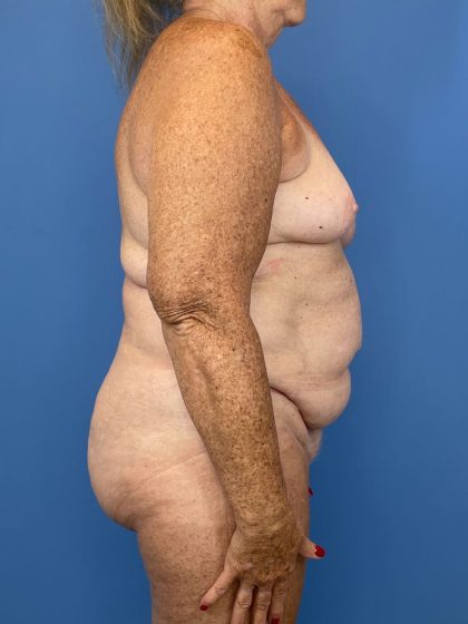 Lipoabdominoplasty Before & After Patient #5489