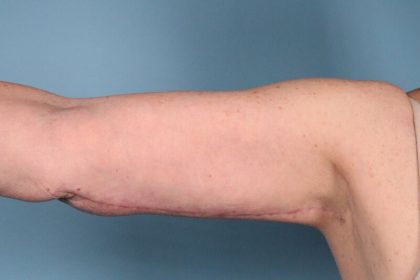 Arm Lift Before & After Patient #5258