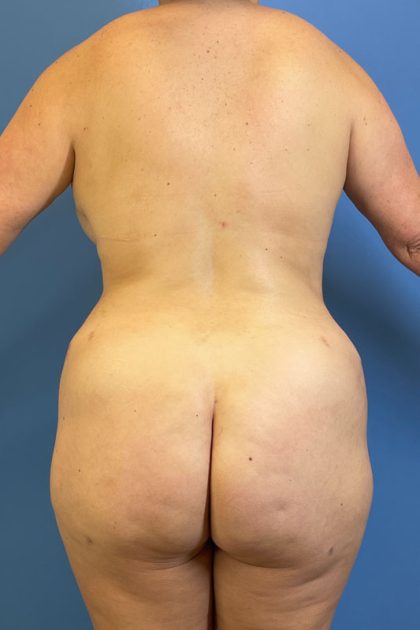 Brazilian Butt Lift (BBL) Before & After Patient #5352