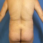 Brazilian Butt Lift Before & After Patient #5376