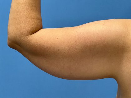 Arm Lift Before & After Patient #5331