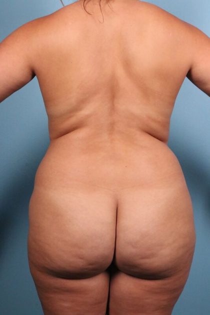 Vaser Liposuction Before & After Patient #5706