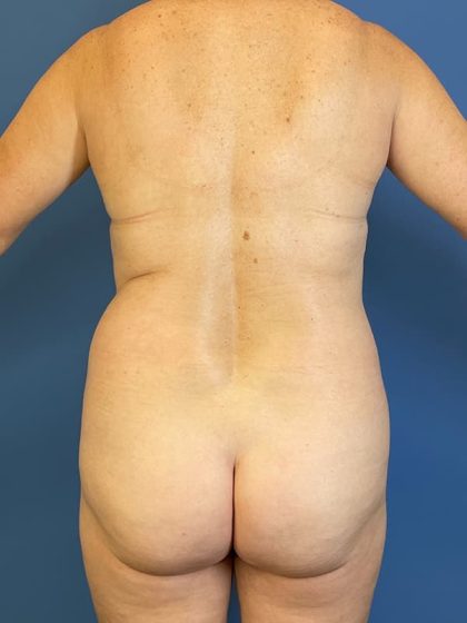 Liposuction Before & After Patient #5711