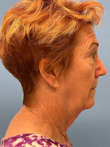Phenol Peel Before & After Patient #6964