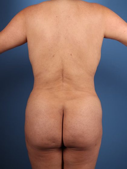 Brazilian Butt Lift (BBL) Before & After Patient #5376