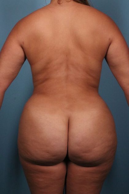 Liposuction Before & After Patient #5706