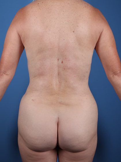 Vaser Liposuction Before & After Patient #5711