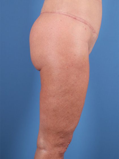 Brazilian Butt Lift Before & After Patient #5377