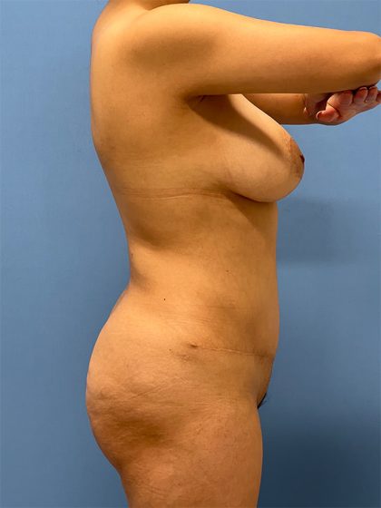 Brazilian Butt Lift (BBL) Before & After Patient #5378