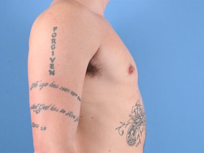 Gynecomastia Before & After Patient #6651